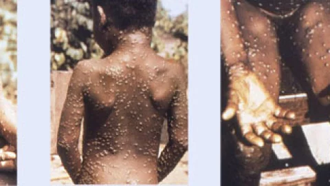 viruela del mono.jpg