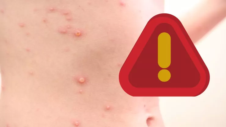 Alerta por sarampión