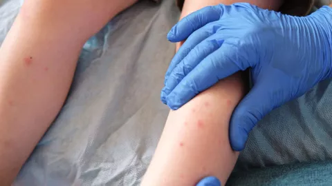 Brote de sarampión obliga a reforzar vacunación en Puebla