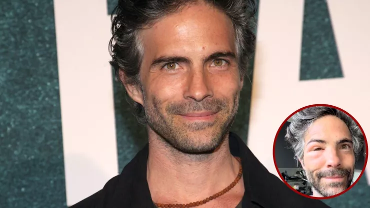 Osvaldo Benavides aparece con el rostro desfigurado; ¿qué le pasó?.jpg