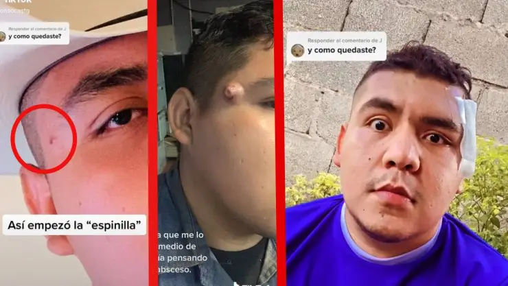 Le sale espinilla y descubre que era un tumor