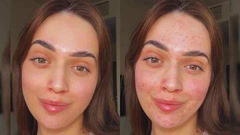 Dermatólogos dan soncejos para tratar granos de la cara