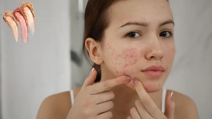 Guía de maquillaje de noche para piel con acné Cobertura natural sin irritación.jpg