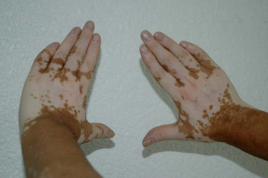 Vitiligo o despigmentación