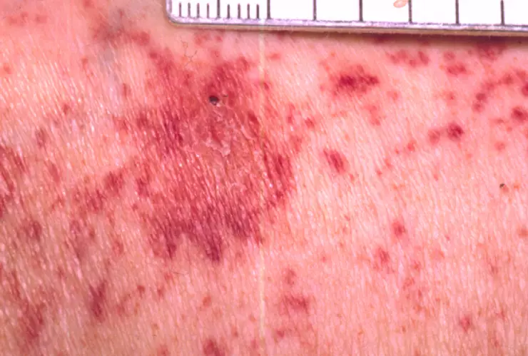 Fiebre manchada de las rocosas.jpg