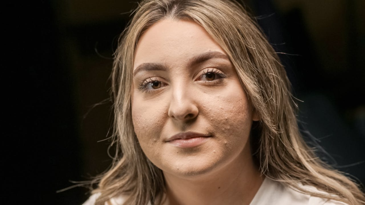 Mujer con acné.