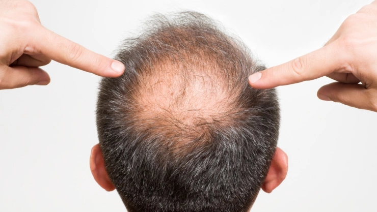 El jugo que tiene fuerte olor, pero ayuda a hacer crecer el cabello y tratar la alopecia