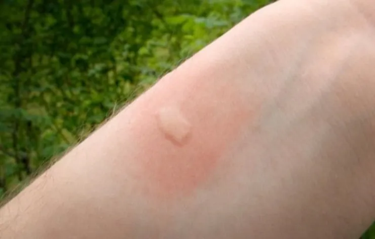 Picadura de mosquito