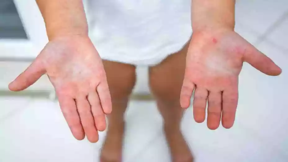 Suspensión de clases_ ¿Por qué suspenderán las clases hasta el 16 de junio por el virus coxsackie, cuáles son los síntomas y municipio afectado