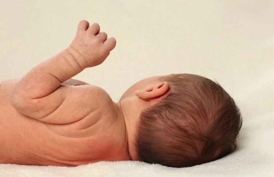 Recién nacido con hiperplasia