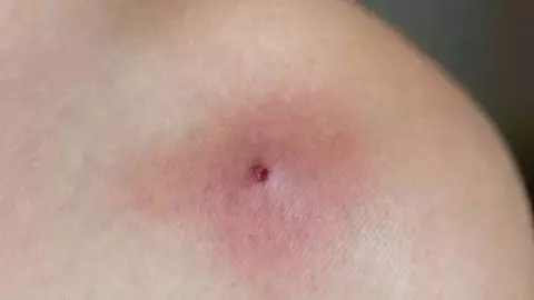 ¡Atención! Casos confirmados de Leishmaniasis en Yucatán: Cómo prevenir la enfermedad y evitar GRAVES afectaciones