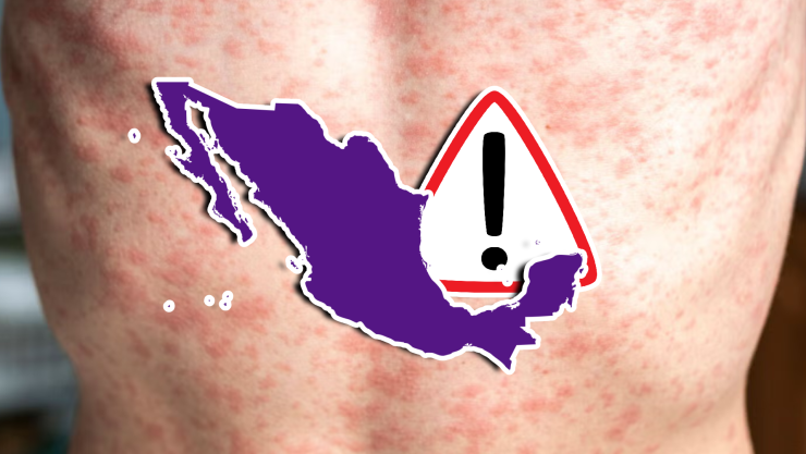 Sarampión en México_ Reportan 24 muertes y más de 5 mil casos; estos son los Estados más afectados.webp