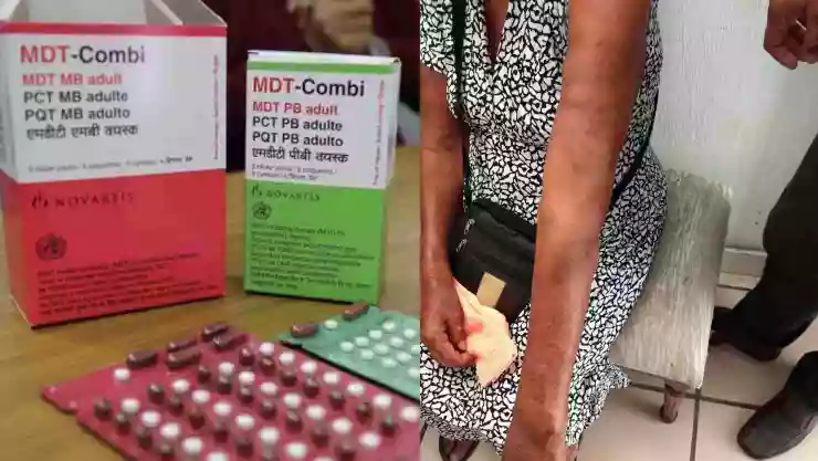 lepra casos confirmados chiapas mexico.jpg