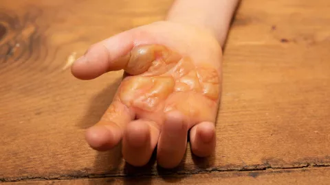 Prenden la estufa y queman a su hijo de 4 años investigan posible maltrato infantil en Tlaquepaque