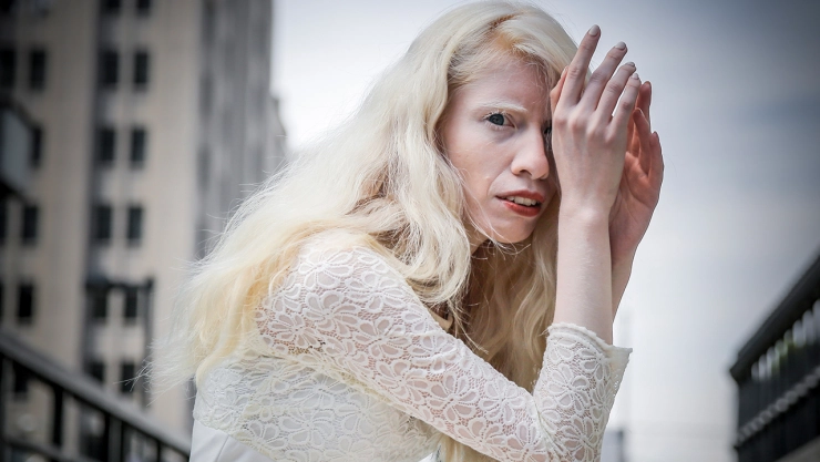 Ruby Vizcarra, albina mexicana