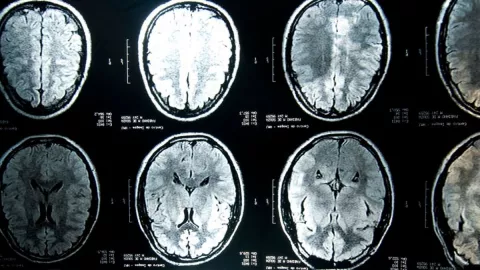 COVID-19, materia gris, cerebro.jpg