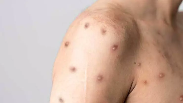 Reportan el primer caso de viruela del mono en Chiapas