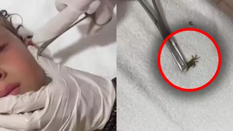 Cangrejo se metió la oreja de un niño en playas de Cancún (VIDEO): ¿cómo pasó y qué le hicieron?