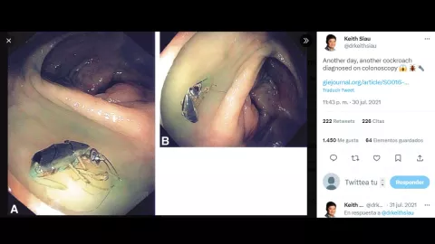 Tenía dolor de estómago; le hallan cucaracha viviendo en el intestino