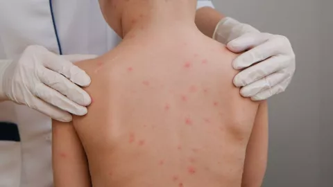 OMS alerta por casos de sarampi&oacute;n en M&eacute;xico