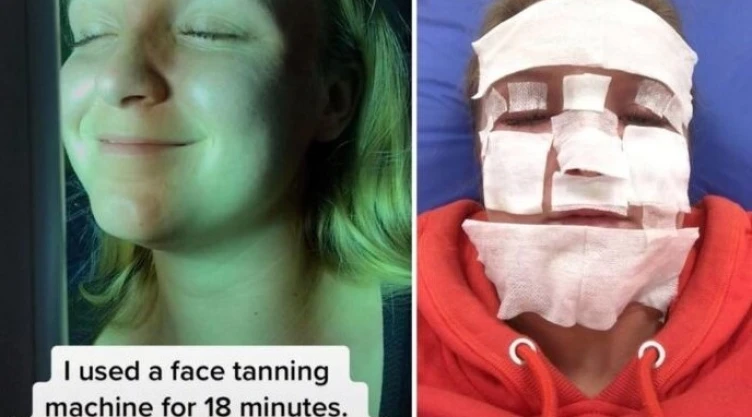Influencer quemaduras cámara de bronceado