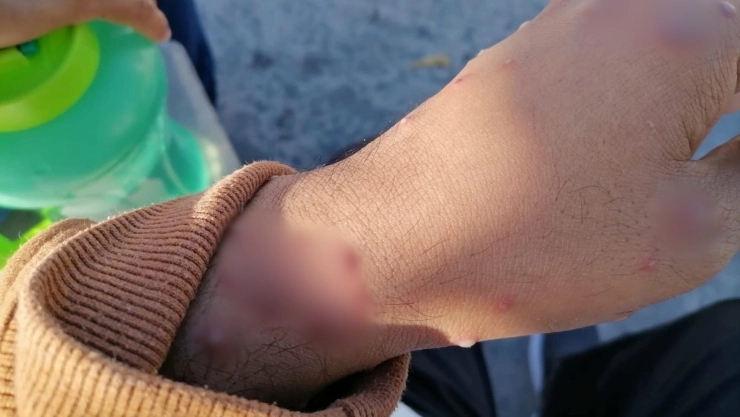 Reportan SEGUNDO CASO de viruela símica en Yucatán; ¿Qué tan peligrosa es?