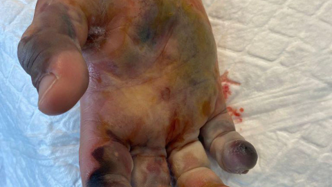 dedos afectados por la picadura de araña.png