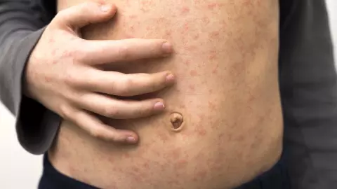 Caso de sarampión en México.