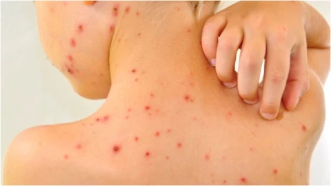 ¿Qué es el sarampión y por qué hay varios casos en Aguascalientes?