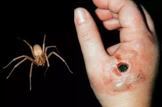 Así podría quedar una mordedura de una araña violinista