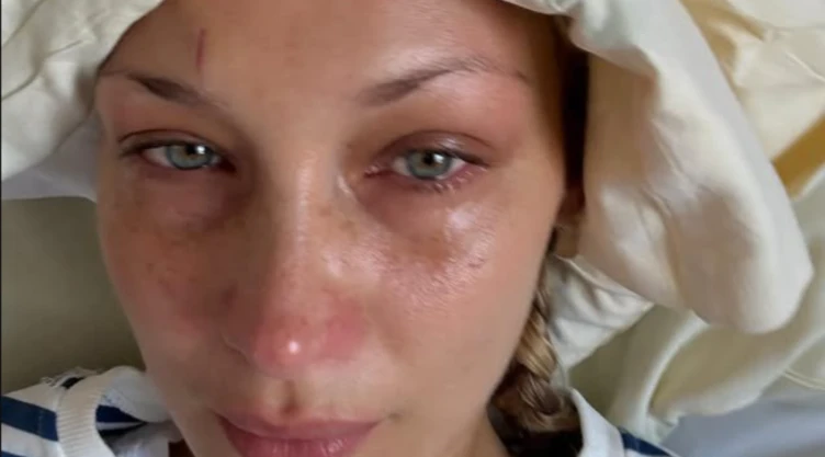 bellahadid-enfermedad.png