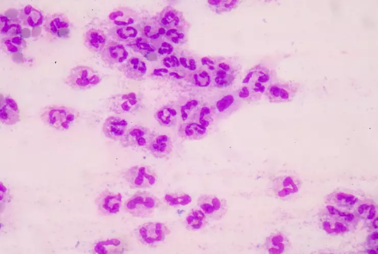 neumococo podría ocasionar la muerte