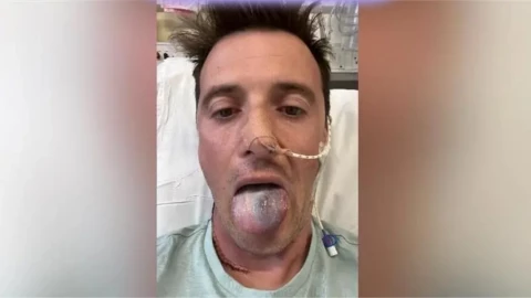 Hombre casi pierde la lengua tras contagiarse del virus del papiloma humano.