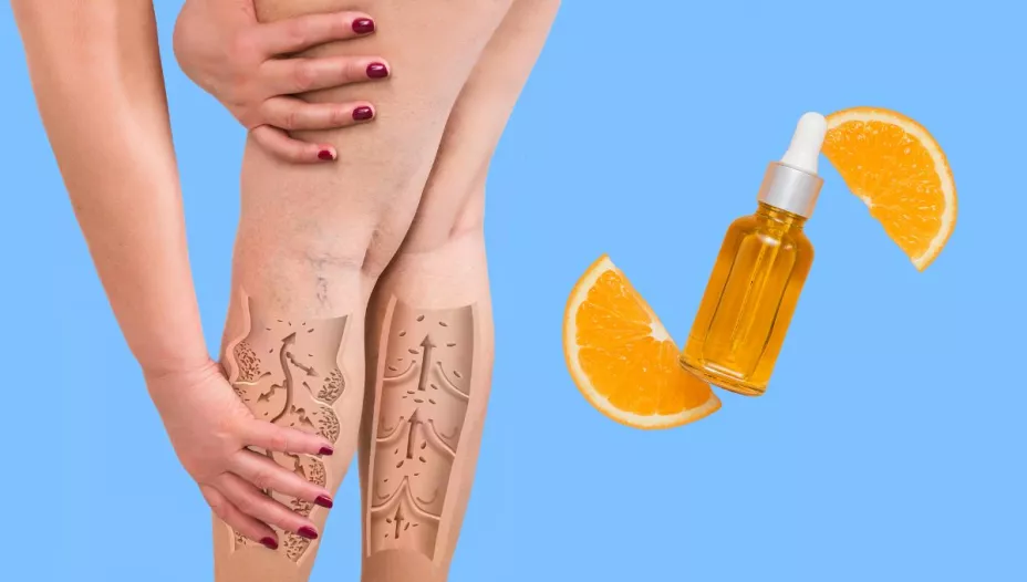Belleza natural: Aceite que promete borrar varices y arañitas con un simple masaje y está causando furor