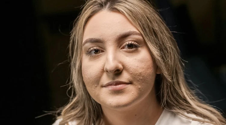 Mujer con acné.