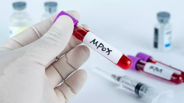 La viruela del mono cambia de nombre; ahora se llamará “mpox”