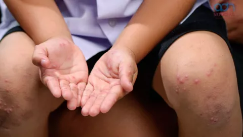 Virus Marburgo: OMS anuncia nuevos casos por propagación, estos son los síntomas