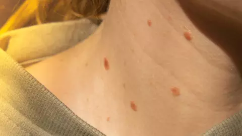 casos de sarampión en Chihuahua