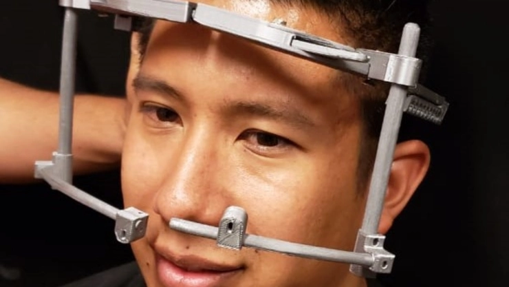 IPN deformaciones craneales