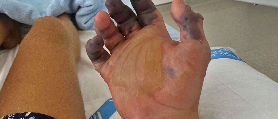 dedos afectados por la picadura de araña violinista.jpg