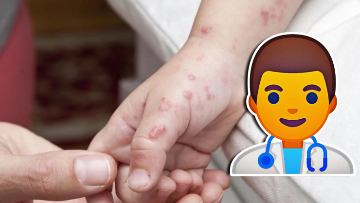 ¿Qué es el virus Coxsackie y cómo afecta a los menores de edad_ Aquí te decimos cómo prevenirla y los síntomas.jpg