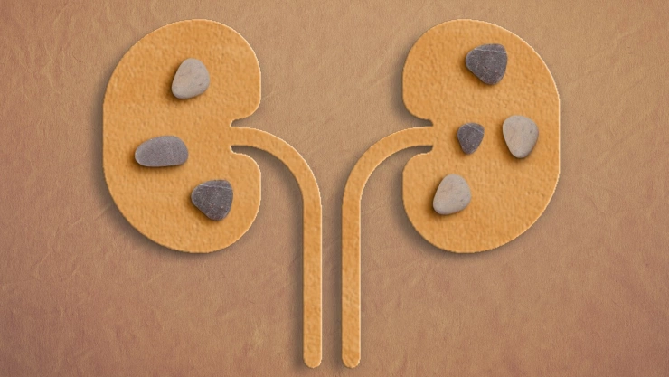 De esta manera podes limpiar las piedras de tus ri&ntilde;ones desde la comodidad de tu hogar