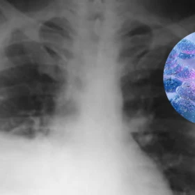 Radiografía de la peste neumónica y síntomas