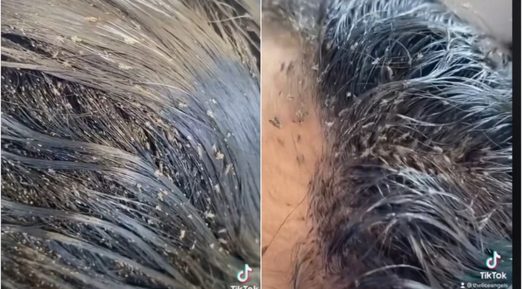 niña piojos TikTok.jpg