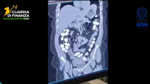 rayos x cuerpo de mujer sudamericana detenida en el aeropuerto da vinci en roma