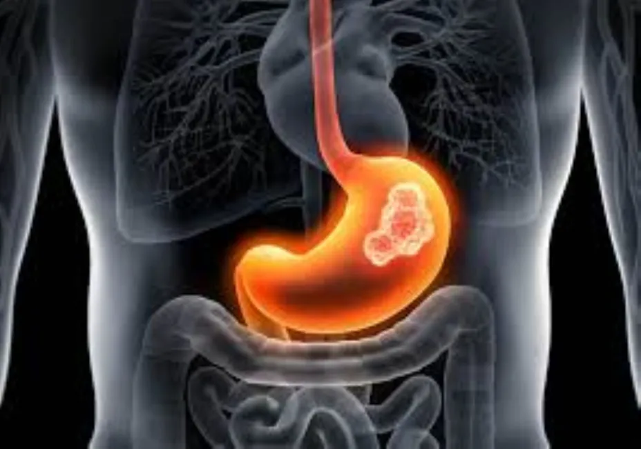 Cáncer Gástrico 1.jpg