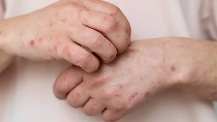 Casos de Sarampión en Baja California