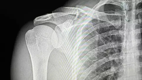 Natanael Cano sufre terrible accidente; muestra en Instagram cómo quedó su clavícula