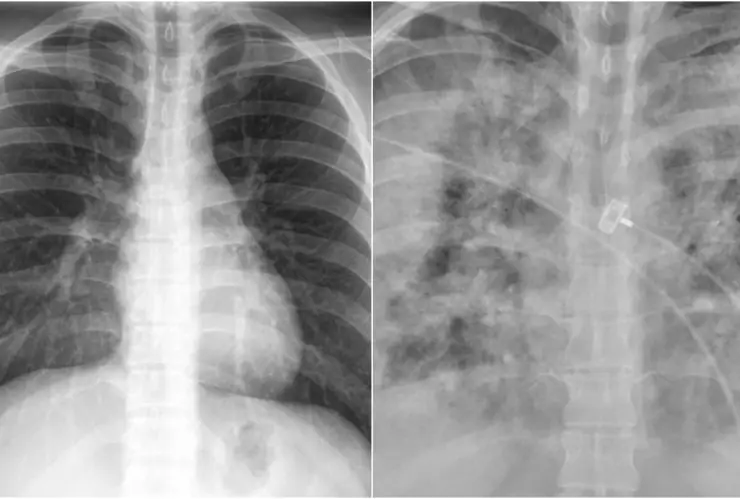 pulmones covid-19 personas no vacunadas.jpg