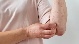 Sarampión en aumento: OMS y CDC alertan que solo una vacunación arriba del 95% puede frenar nuevos brotes